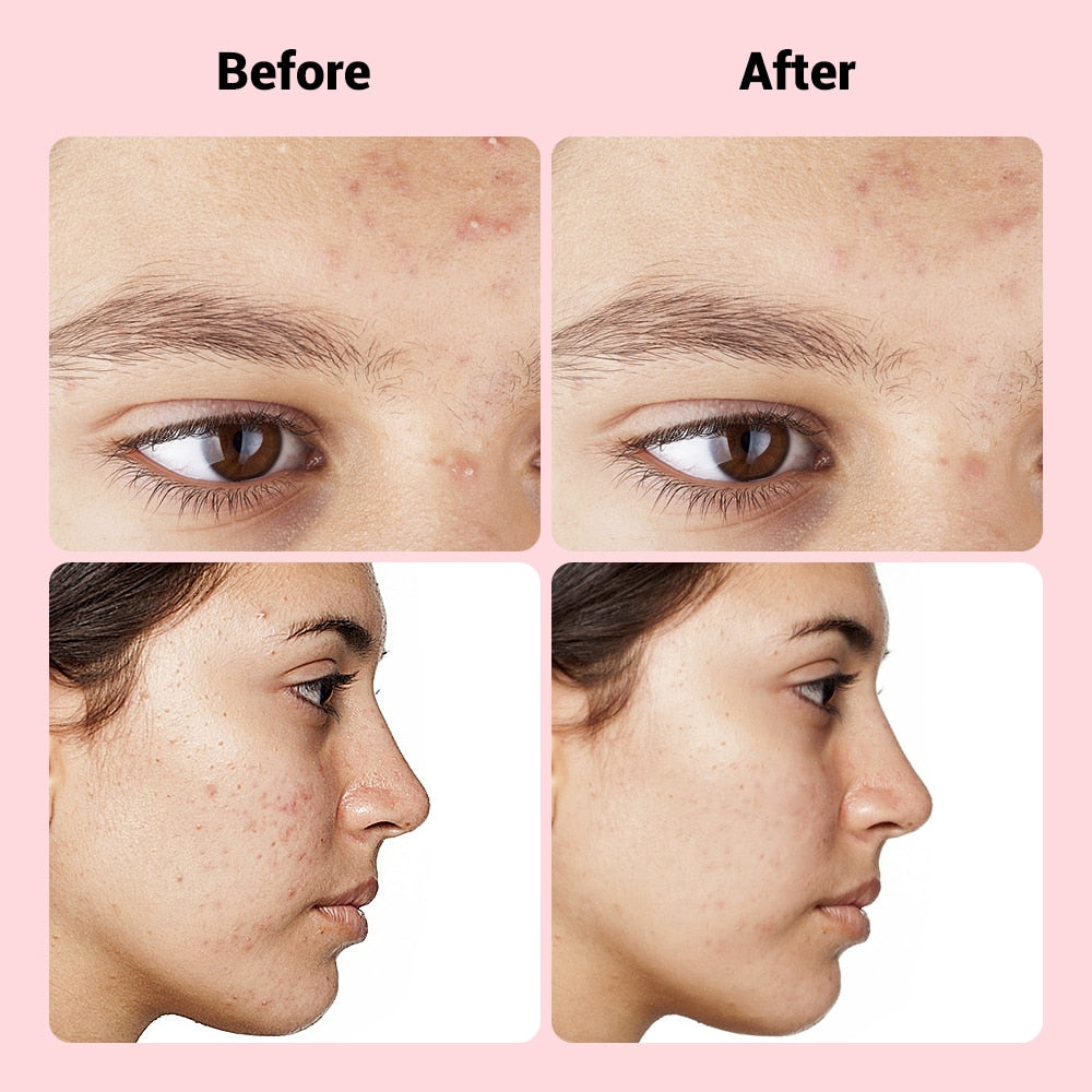 9pcs Translucent Microneedle Pimple Patch Acne Master Treatment Sticker Face Beauty Skin Care Tool Tape Skincare