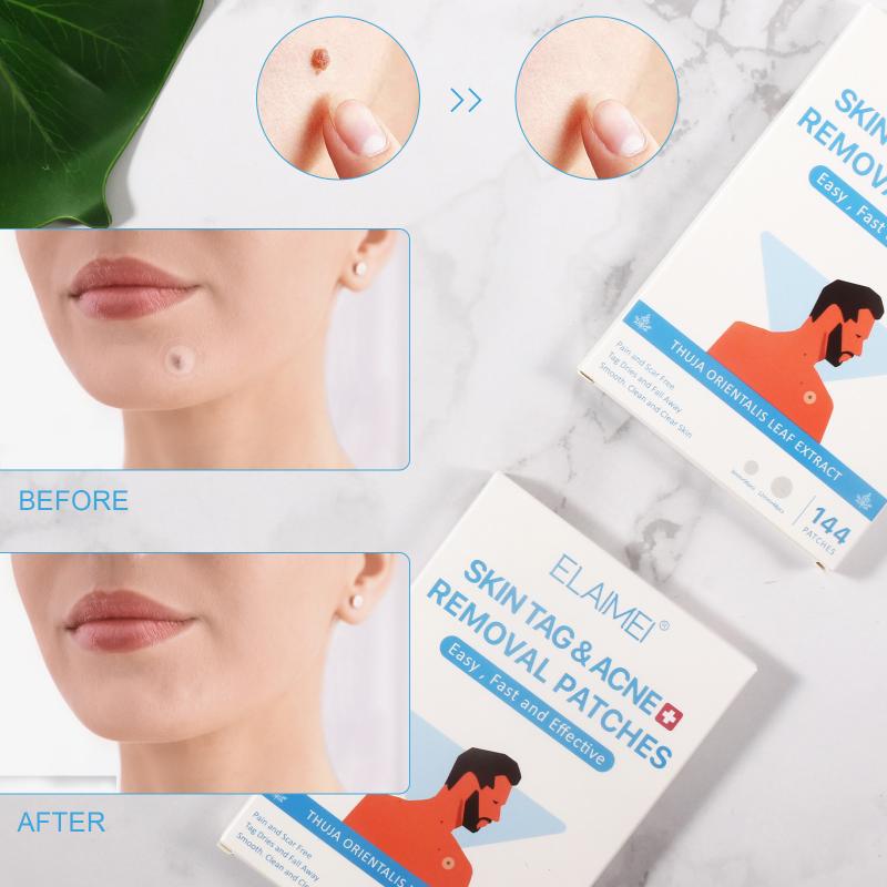 144Pcs Skin Tag Remover Patch Ance Pimple Patch Reatment Hydrocolloid Patch Protecting Skin Patch